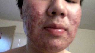 My First Day On Accutane [upl. by Kerianne]