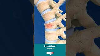 Spine Fracture Kyphoplasty ↪ 3D Medical Animation Shorts Kyphoplasty KyphoplastySurgery Spine [upl. by Nihhi]