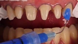 Adhesive cementation of ceramic veneers [upl. by Nena485]