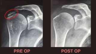 Dr Bruno LEVY  Traitement arthroscopique des calcifications de lépaule [upl. by Gerhardt]