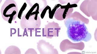 Giant Platelet on Peripheral Blood Smear Hemepath Hematology Pathology [upl. by Yoko]