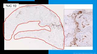 PDL1 Testing by Immunohistochemistry [upl. by Kooima]