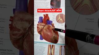 Heart Attack amp it’s treatment । हार्ट अटैक एवं इसका इलाज [upl. by Hiller554]