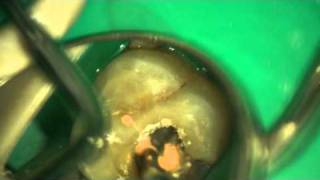 Dr Vinod  Root Canal Treatment Filling of root canal using elements obturation unit sybronendo [upl. by Islaen499]