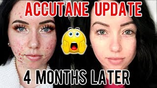 MY ACCUTANE JOURNEY 4 MONTH UPDATE Before amp After Progress Side Effects [upl. by Aryamo]