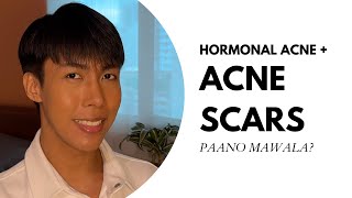 Paano mawala ang Hormonal Acne at Acne Scars Based on my PERSONAL EXPERIENCE [upl. by Marlow]