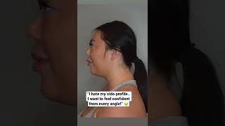 How To Lose Facial Fat  Buccal fat removal and chin liposuction beforeandafter [upl. by Isaac833]