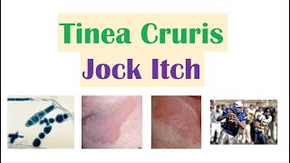 Jock Itch Tinea Cruris  Causes Risk Factors Signs amp Symptoms Diagnosis and Treatment [upl. by Jehial]