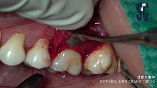 Technique to debridement with furcation [upl. by Hsekar554]