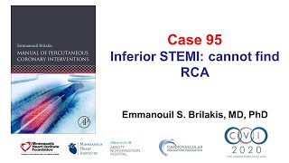 Case 95 PCI Manual  STEMI and unable to engage [upl. by Romeo646]