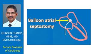 Balloon Atrial Septostomy [upl. by Bornstein]