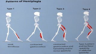 Gait patterns in Children with hemiplegic cerebral Palsy [upl. by Clawson883]