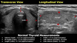 How To Measure Thyroid On Ultrasound  Length Width AP Depth amp Volume Measurements USG [upl. by Ayarahs]