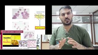 G6PD deficiency انیمیا الفول [upl. by Nonnah]