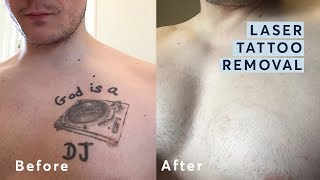 Laser Tattoo Removal  Before and After through all the stages [upl. by Dora]