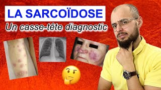 La SARCOÏDOSE  Une maladie digne dun épisode de Dr HOUSE [upl. by Farlie]