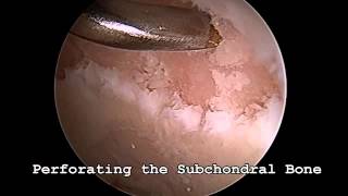 Hip Arthroscopy Acetabular Microfracture [upl. by Noiek]