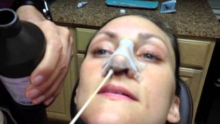 Rhinoplasty Recovery days 1 through 7 Nose Cleaning Instructions  Dr Naderi [upl. by Sharpe550]