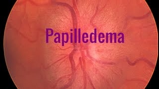 Papilledema A Swollen optic disc [upl. by Ibbie]