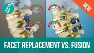 Facet Joint Replacement Vs Spine Fusion [upl. by Randie]