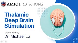 Michael Lu Thalamic Deep Brain Stimulation for Closed Head injury [upl. by Suolkcin]