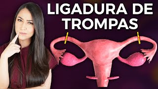 ¿Cómo se hace una LIGADURA DE TROMPAS o salpingoclasia👩🏻‍⚕️ drapauzuniga [upl. by Reggi]