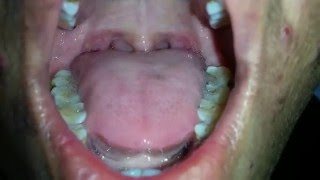 Tongue Fasciculation in MND [upl. by Bremer]