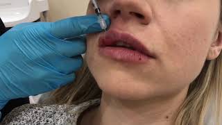 Lip Filler Treatment at Canada MedLaser Clinics [upl. by Maitland492]