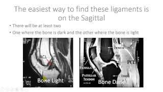 Read Knee MRI ACL and PCL  Help with Reading MRI [upl. by Iolenta]