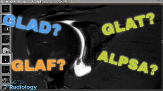 MRI of Glenoid Labral Flap Tear  A Pathognomonic Lesion Rare [upl. by Aracat356]