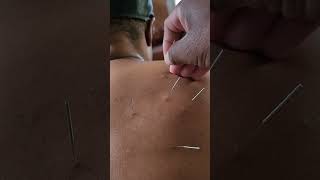 acupuncture needle needling upper back pain shortness of breath creating anxiety [upl. by Mathias]