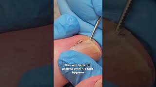 Toenail Debris 🦶 footwellness nails foot [upl. by Suh]