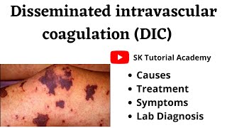 Disseminated intravascular coagulation  DIC syndrome [upl. by Anibor]