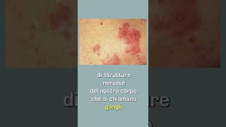 Nevralgia posterpetica e quotfuoco di SanAntonioquot Dott Antonio Musio neurochirurgo herpeszoster [upl. by Lehcyar]