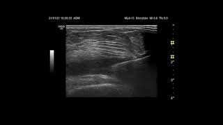 Ultrasound guided intraarticular kneeinjection [upl. by Oirasec]