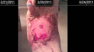 2nd Degree burns on foot  healing time lapse  2 months [upl. by Sieber]