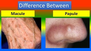 Difference Between Macula and papule [upl. by Eey]