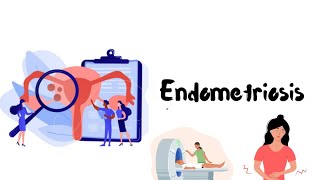 Endometriosis Aetiology Pathogenesis Pathophysiology  sign and symptoms and investigation [upl. by Laup]