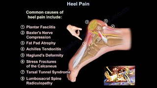 Heel Pain causes and treatment plantar fasciitis diagnosis and treatment [upl. by Dranyam486]