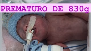 PREMATURO DE 26 SEMANAS 830 GRAMAS ANTES E DEPOIS maternidade utineonatal viral prematuro [upl. by Daryl514]