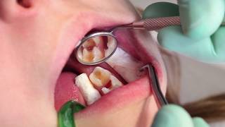 What to do when a tooth has a deep carious lesion [upl. by Avirt]