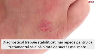 Artrita psoriazică Simptome și tratament [upl. by Alemak]