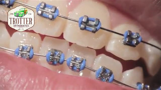 Watch How Braces Are Put On  Orthodontic Treatment Using Fixed Brackets Redondo Beach Orthodontist [upl. by Hnahk]