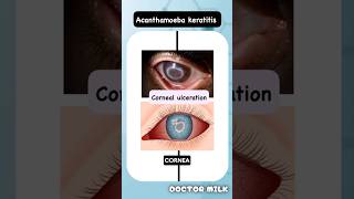 Acanthamoeba keratitis neetpg usmle ophthalmology [upl. by Shien254]