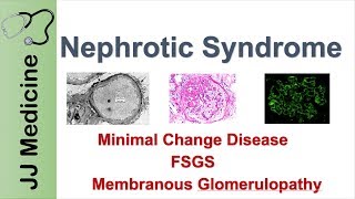 Nephrotic Syndrome  Clinical Presentation Causes and Treatment [upl. by Avivah]