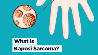 Kaposi sarcoma Definition Causes Types Symptoms Diagnosis Treatment [upl. by Bay]