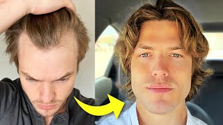 My Turkey Hair Transplant Results After 1 Year  Before amp After [upl. by Lada]