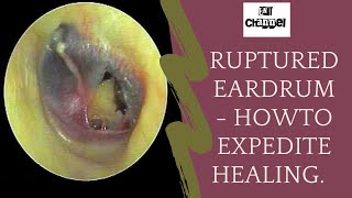 Ruptured eardrum I what should you do after traumatic perforation of tympanic membrane [upl. by Avivah]