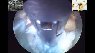 Percutaneous Endoscopic Transforaminal Lumbar Discectomy PETLD by Dr Hyeun Sung Kim02 [upl. by Gokey]