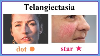 telangiectasia [upl. by Arabele]